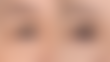 ยกกระชับคิ้ว แก้ปัญหาตาตก