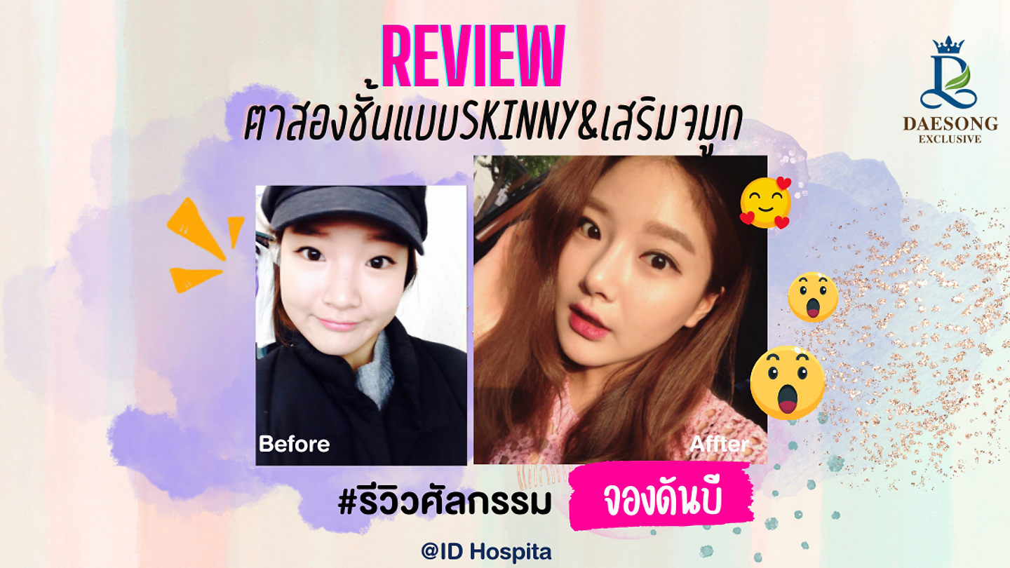 #รีวิวศัลยกรรมตาสองชั้นแบบSkinny&เสริมจมูก@ID Hospital (ตอนที่ 2)