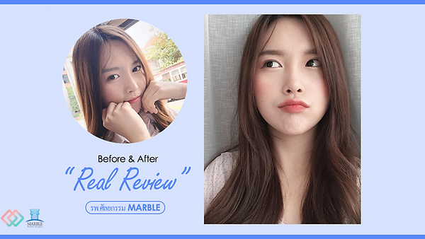 รีวิวแก้จมูกทรงสวย ครั้งเดียวจบ กับคุณภาวิตา (ตอนที่ 2)