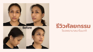 รีวิวศัลยกรรมจมูก