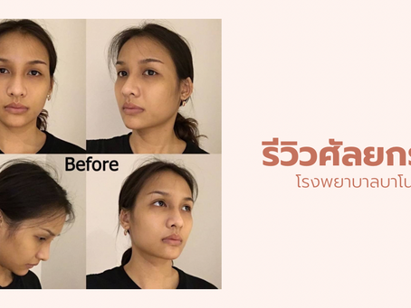 รีวิวศัลยกรรมจมูก