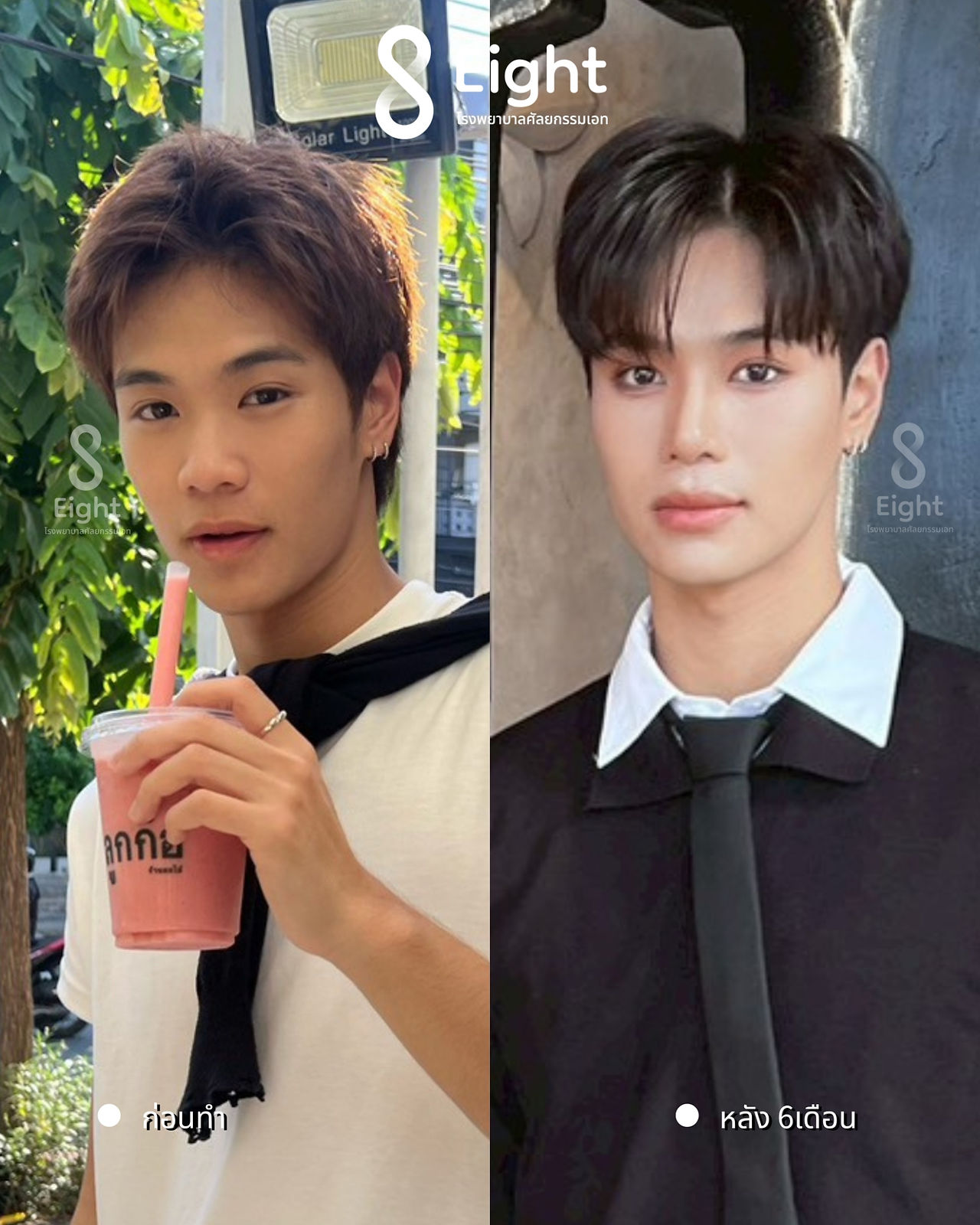 รีวิวศัลยกรรมผู้ชาย โรงพยาบาลศัลยกรรมเกาหลีเอท Eight Plastic Surgery