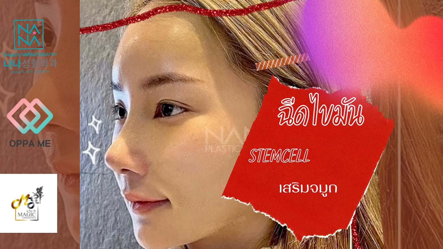 ฉีดไขมันStemcell+เสริมจมูก (ตอนที่ 2)