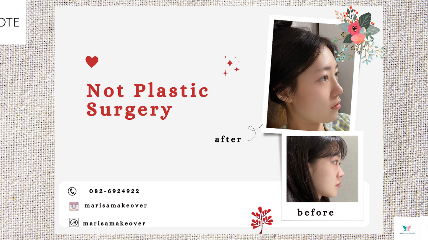 รีวิวศัลยกรรมเสริมจมูก (ตอนที่ 5)