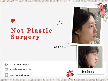 รีวิวศัลยกรรมเสริมจมูก