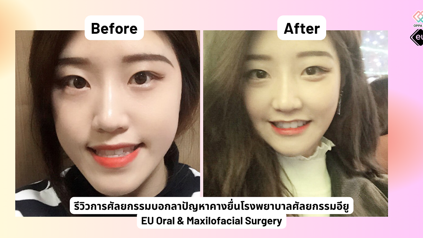 รีวิว การศัลยกรรมบอกลาปัญหาคางยื่นโรงพยาบาลศัลยกรรมอียู (EU Oral & Maxillofacial Surgery)