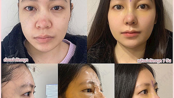 ทำจมูกอย่างเดียว หน้าเปลี่ยนเลยค่า ที่ ID เท่านั้น (ตอนที่ 1)