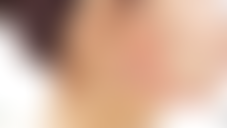 การลดขนาดกราม MVT