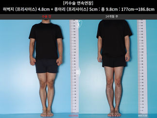 รีวิวผ่าตัดเพิ่มส่วนสูง