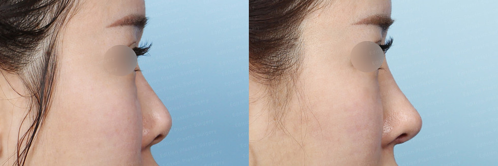 รีวิวเสริมจมูก แก้จมูก โรงพยาบาลศัลยกรรมเอดิชั่น (Edition Plastic Surgery)