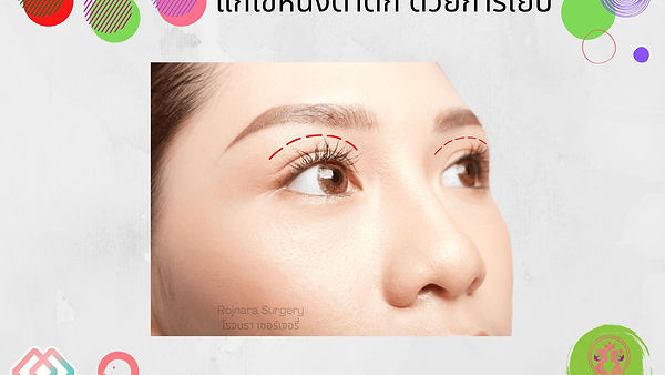 แก้ไขหนังตาตก ด้วยการเย็บ @Atop Plastic Surgery