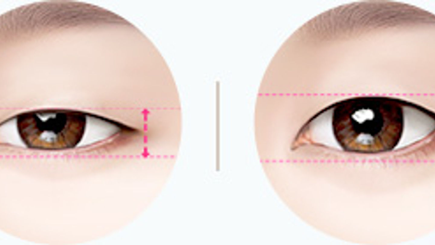 ศัลยกรรมตาผู้ชาย แก้ไขรูปตาที่ ID