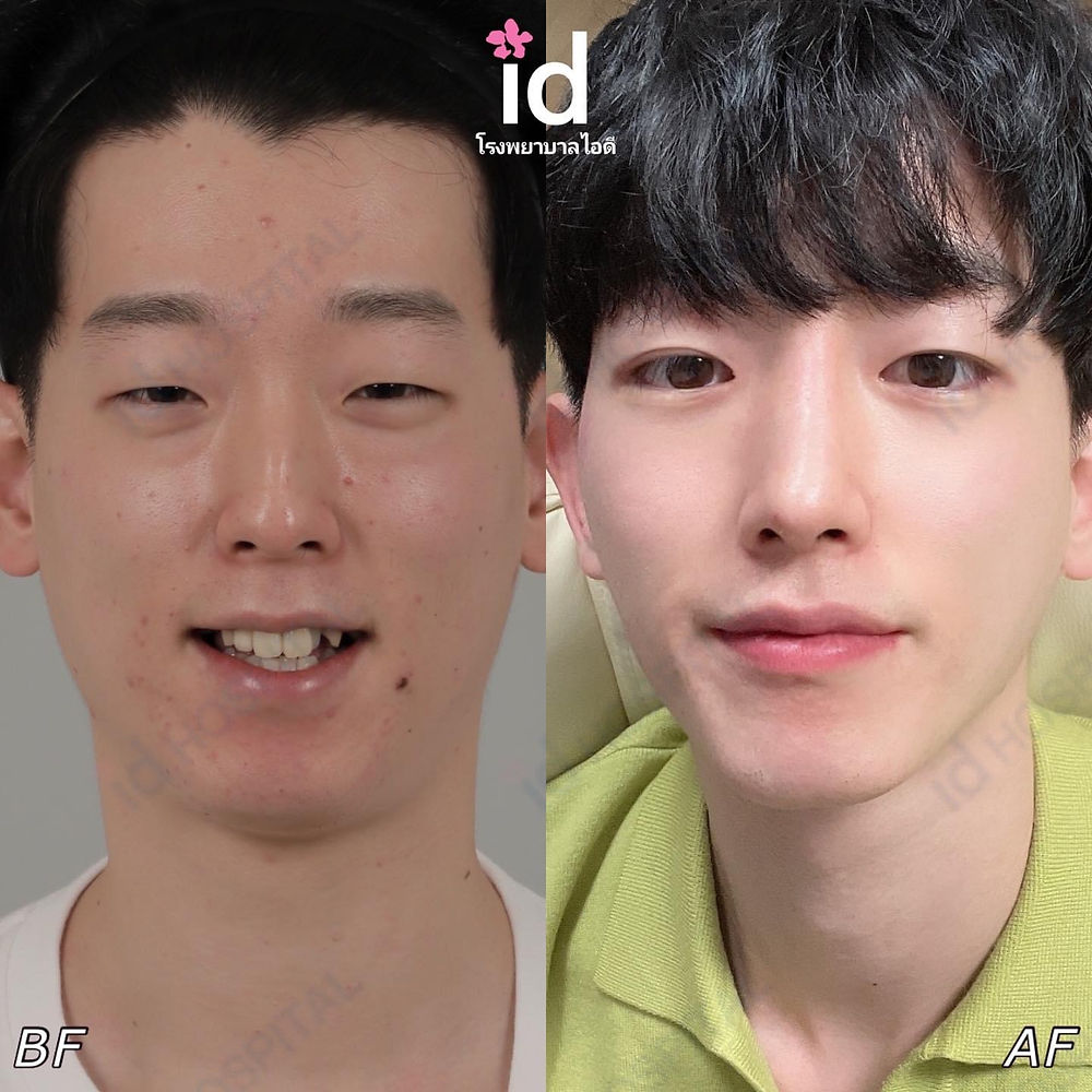 รีวิวศัลยกรรมผู้ชาย เกาหลี