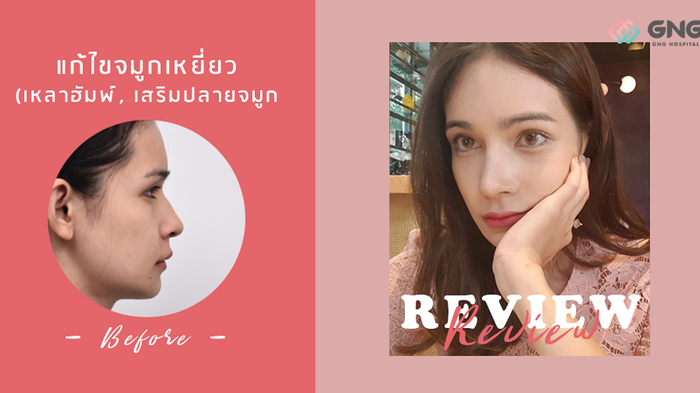 รีวิวเสริมจมูก (เหลาสันจมูก) คุณเจมม่า (ตอนที่ 2)