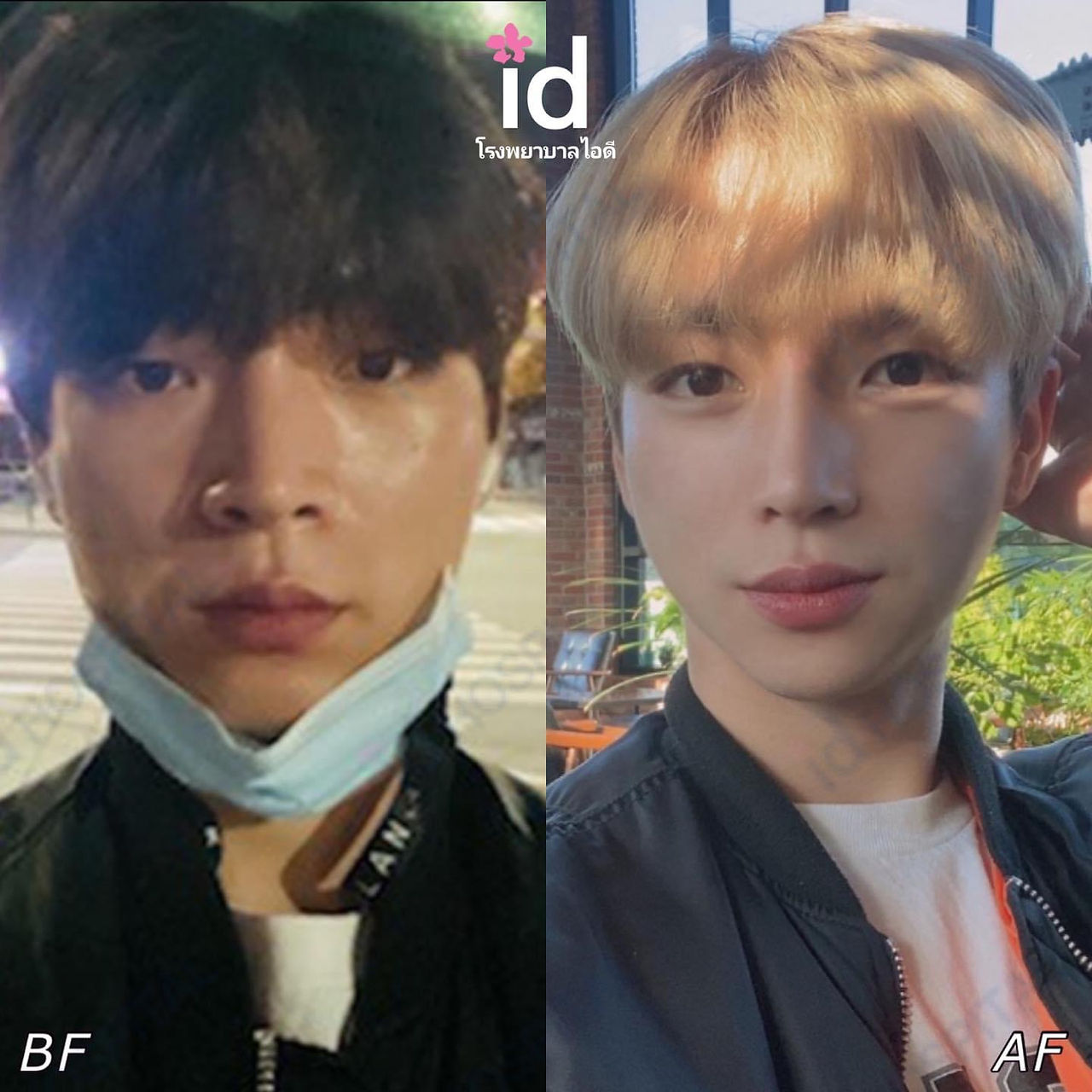 รีวิวศัลยกรรมเกาหลี