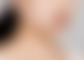 ปัญหาใบหน้าใหญ่ อาจเกิดจากไขมันกระพุ้งแก้ม!