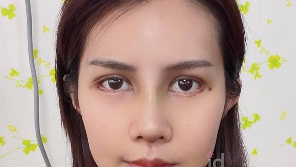 รีวิว ตา2ชั้น รีวิวจมูกงานเเก้ เเค่7วันก็ยุบบวมเเล้ว (ตอนที่ 1)