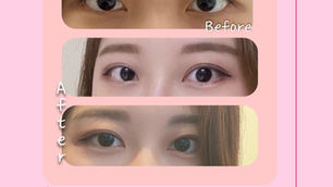 ตาสองชั้นแบบธรรมชาติที่ Note plastic surgery