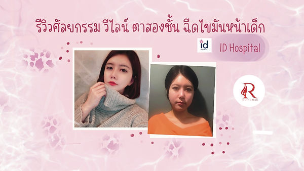 “รีวิวโรงพยาบาล ID” [ศัลยกรรมวีไลน์,ตาสองชั้น,ฉีดไขมันหน้าเด็ก] (ตอนที่ 1)