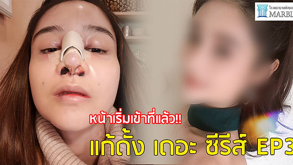 รีวิว【แก้ดั้ง เดอะ ซีรีส์ EP3】เปิดประสบการณ์ครั้งแรกแก้ดั้งใหม่รอบที่ 4 ที่ Marble Plastic Surgery H (ตอนที่ 1)