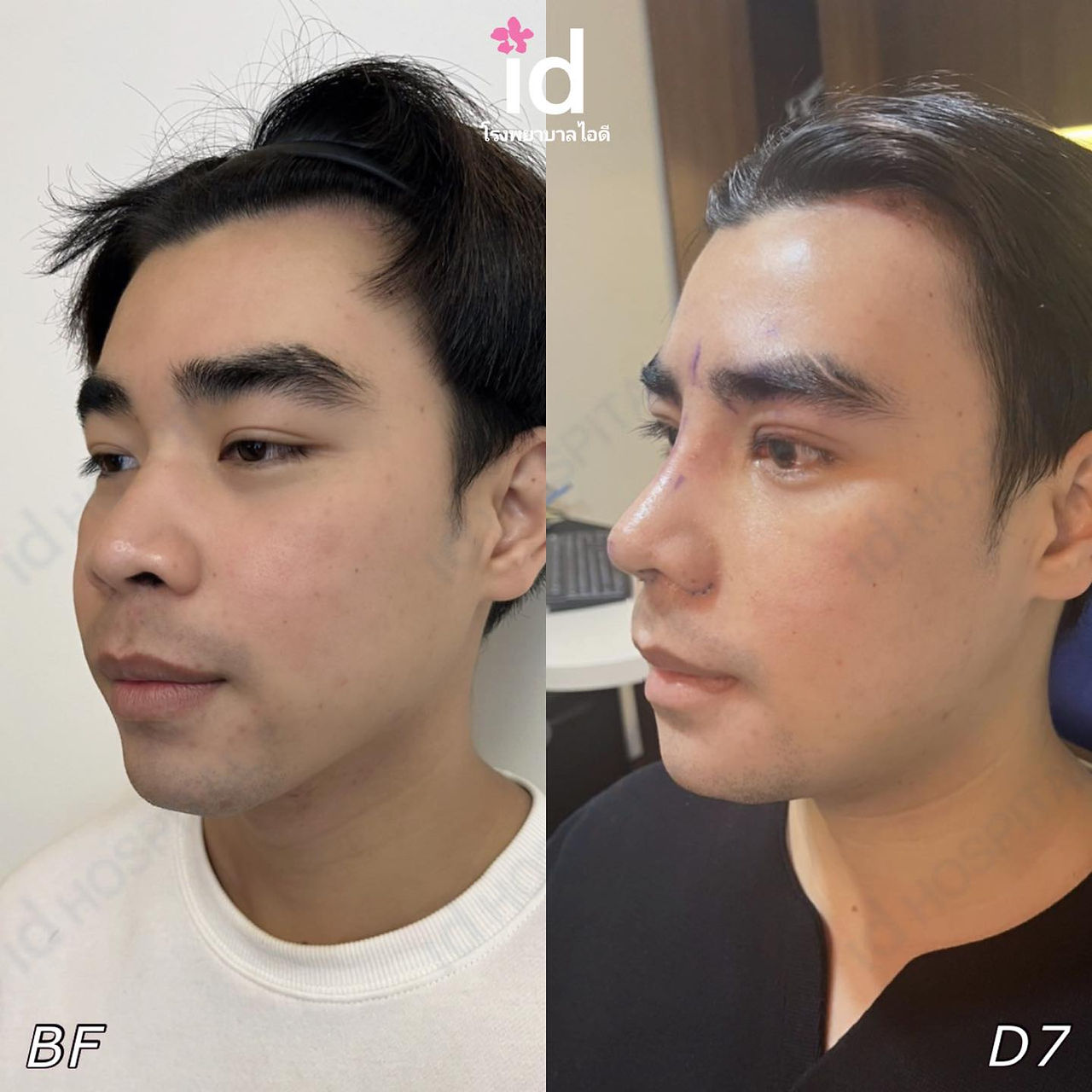 รีวิวศัลยกรรมผู้ชาย > โรงพยาบาลไอดี (ID Hospital)