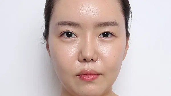 รีวิวปรับรูปหน้า 3 จุด ดูดไขมันเหนียงและกรอบหน้า (ตอนที่ 3)