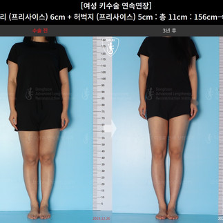 ผ่าตัดเพิ่มความสูง