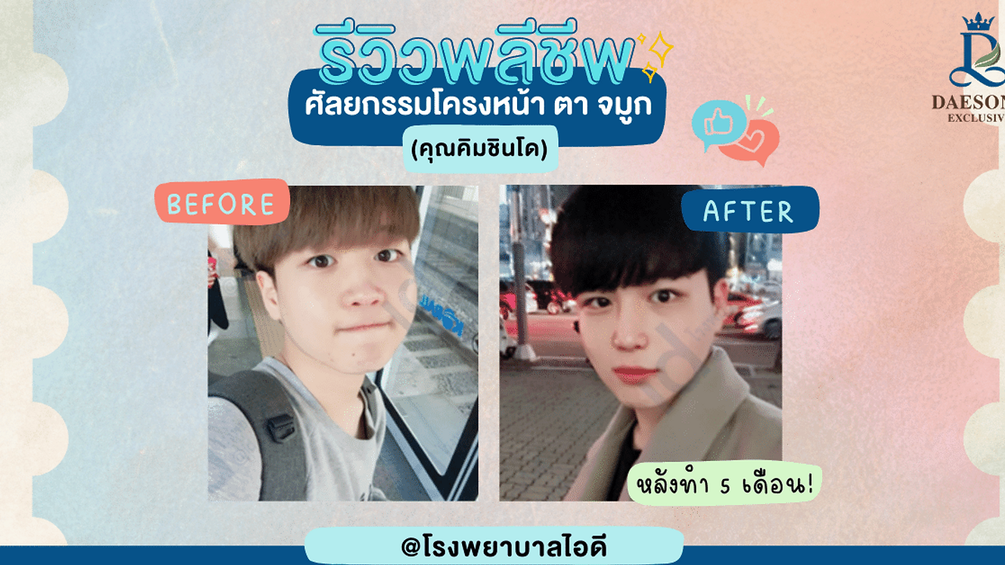 รีวิว! ศัลยกรรมโครงหน้า ตา จมูก ID (ตอนที่ 1)