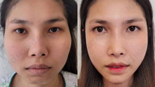 Beauty Tips: 7 ข้อควรรู้ เกี่ยวกับกาทำศัลยกรรมปรับโครงหน้า
