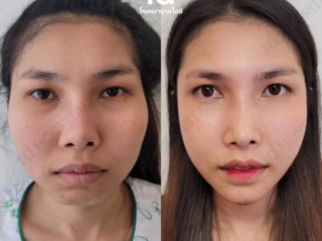 Beauty Tips: 7 ข้อควรรู้ เกี่ยวกับกาทำศัลยกรรมปรับโครงหน้า