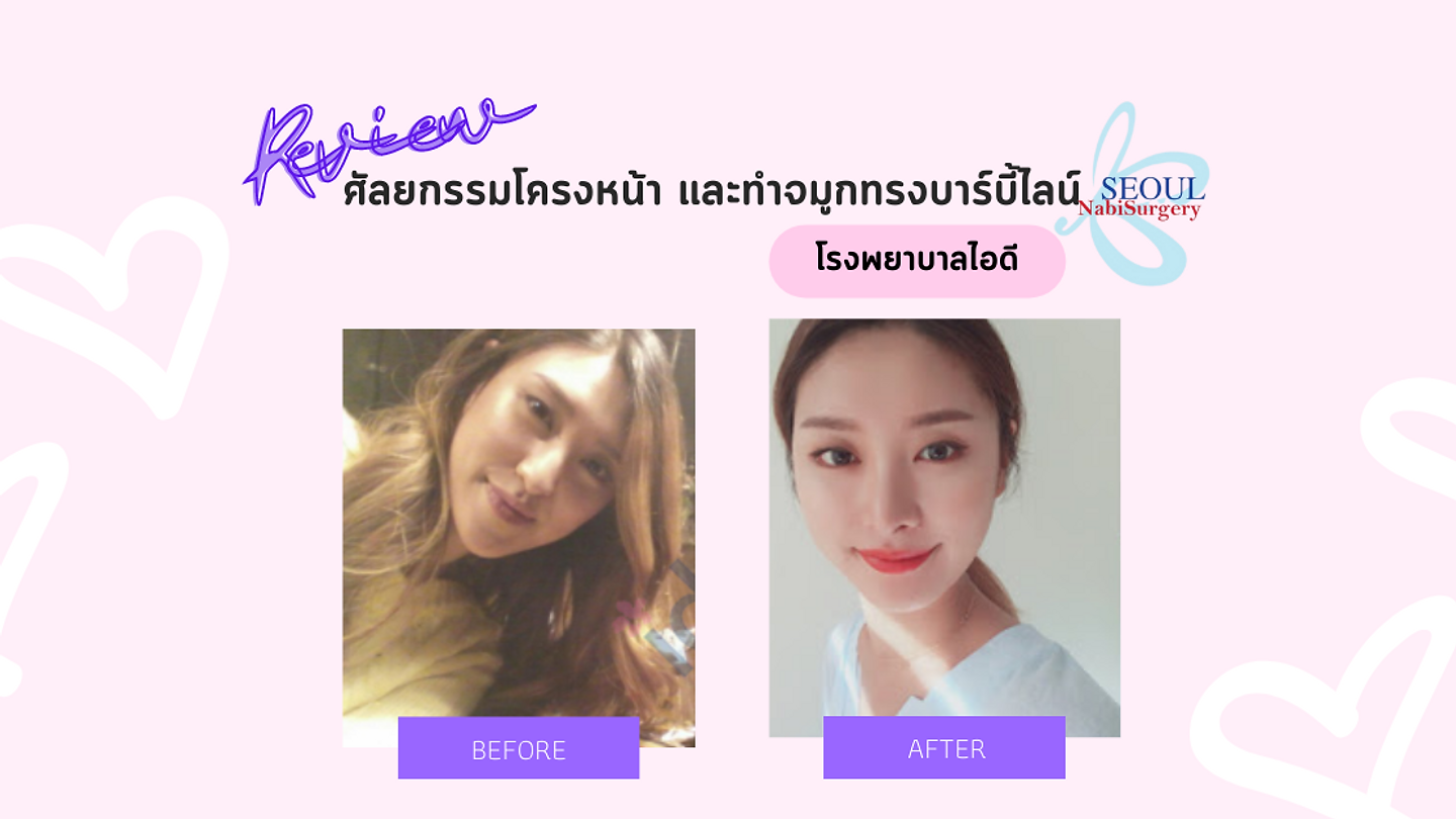 รีวิวศัลยกรรมโครงหน้า และทำจมูกทรงบาร์บี้ไลน์ (ตอนที่ 1)