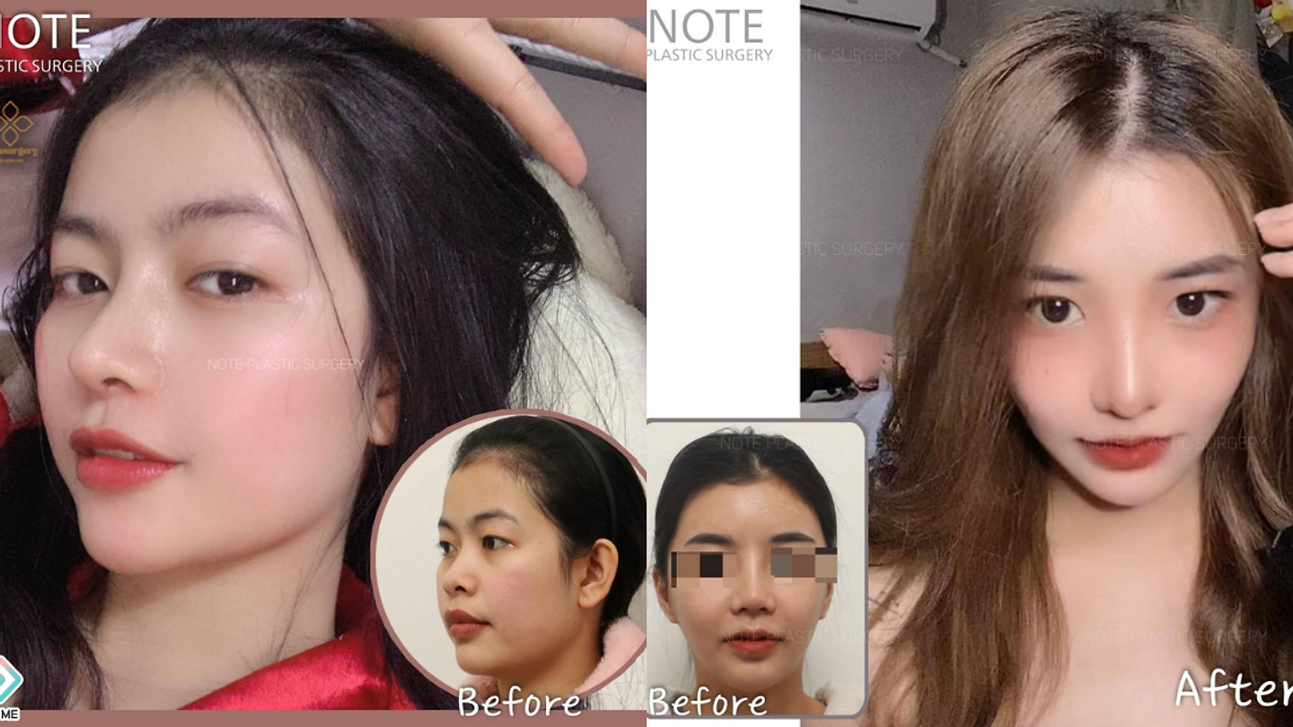 Note Plastic Surgery รีวิวจมูกงานแรก+ ปรับโครงหน้าโหนกแก้ม ,กราม ,คาง ( แบบไม่มีหมุดยึด ) (ตอนที่ 1)