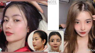 Note Plastic Surgery รีวิวจมูกงานแรก+ ปรับโครงหน้าโหนกแก้ม ,กราม ,คาง ( แบบไม่มีหมุดยึด )
