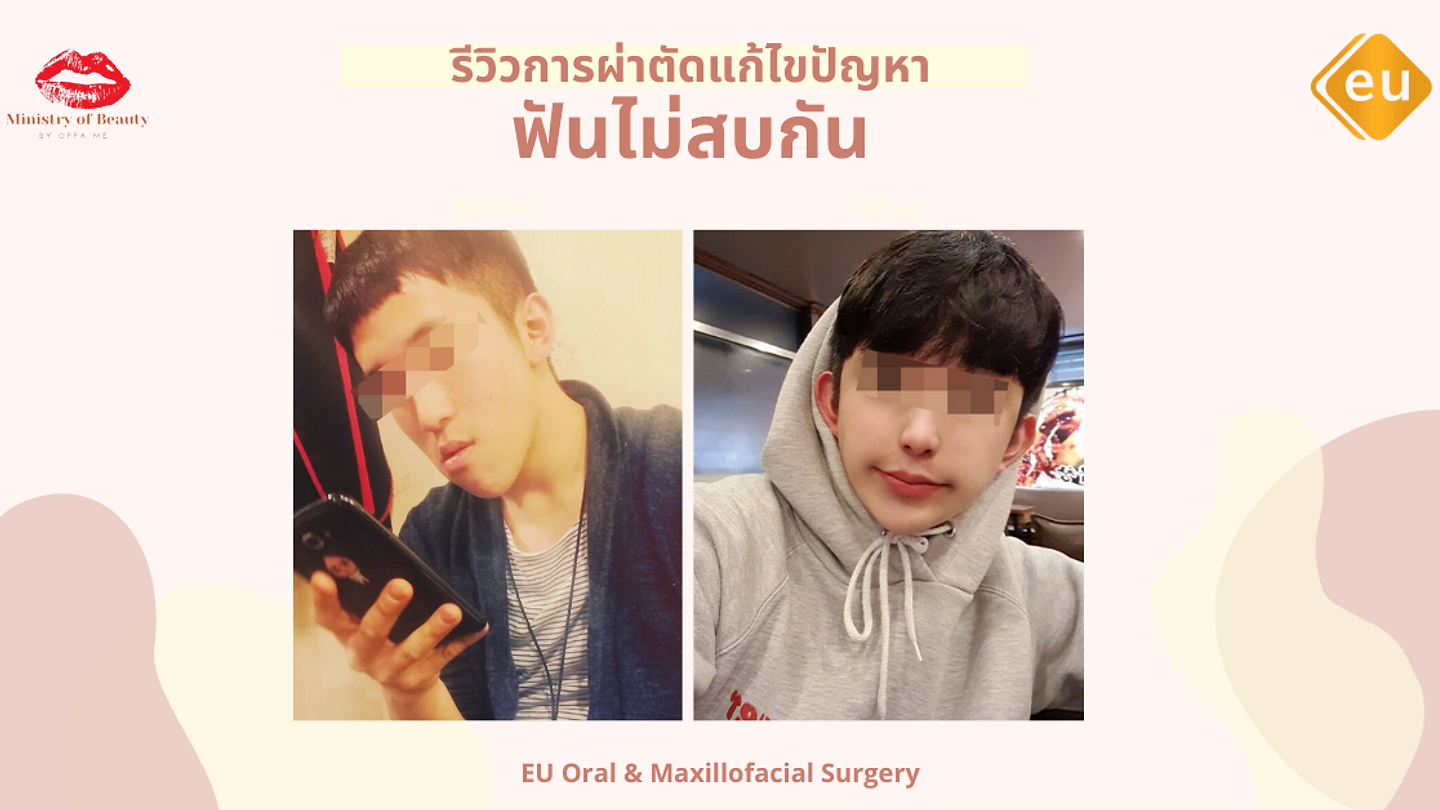 รีวิวการผ่าตัดแก้ไขปัญหาฟันไม่สบกัน (ตอนที่ 1)