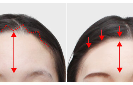 แก้ปัญหาหน้าผากกว้าง