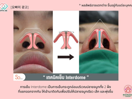 การเสริมจมูกเทคนิคต่างๆ Someko Clinic (โซเมโกะ คลินิก) ตอนที่ 2