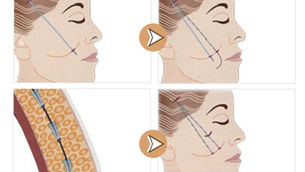 ยกกระชับ บริเวณใบหน้าให้ดูอ่อนเยาว์