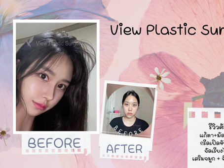 รีวิวศัลยกรรม แก้ตา+มัดกล้ามเนื้อตา ,กรีดเปิดหัวตา+หางตา ,จัดเรียงไขมันใต้ตา,เสริมจมูก+ฉีดไขมันใบหน้
