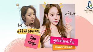 รีวิวศัลยกรรม วีไลน์ แก้จมูก ID HOSPITAL