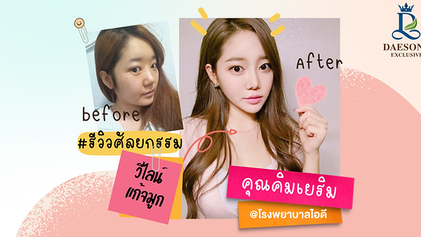 รีวิวศัลยกรรม วีไลน์ แก้จมูก ID HOSPITAL (ตอนที่ 1)