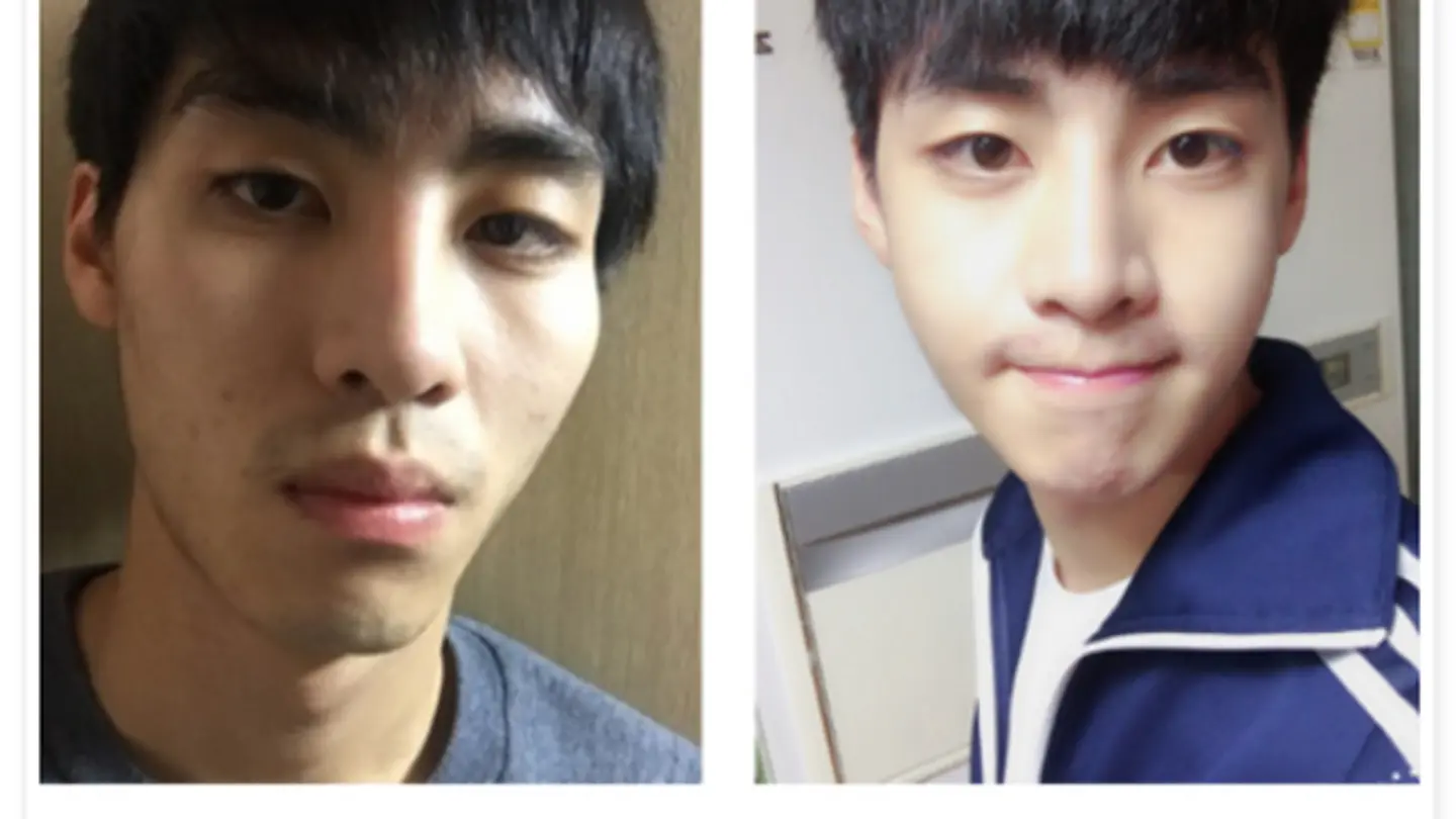 รีวิว ปรับรูปหน้า สร้างความละมุน คุณชเวกุน (ตอนที่ 3)