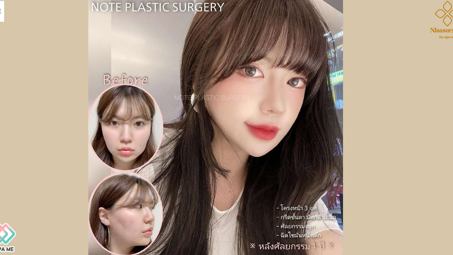 Note Plastic Surgery รีวิวศัลยกรรมจมูก (ตอนที่ 2)