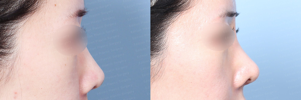 รีวิวเสริมจมูก แก้จมูก โรงพยาบาลศัลยกรรมเอดิชั่น (Edition Plastic Surgery)