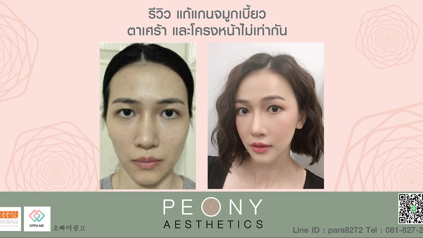 รีวิว แก้จมูกเบี้ยว ตาเศร้า โครงหน้าไม่เท่ากัน (ตอนที่ 2)