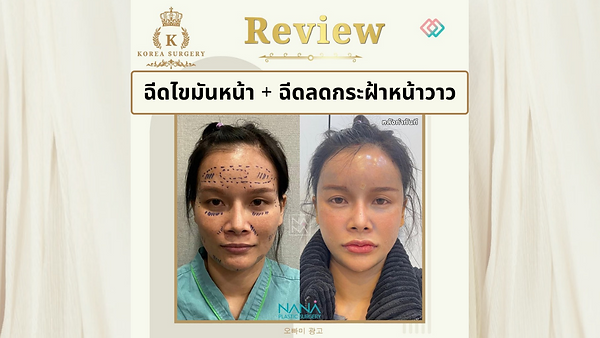 รีวิว ฉีดไขมันหน้าเด็กละมุน มาก !!!! แถม ผิว ขาวใส ดูไม่โทรมจ้าาา