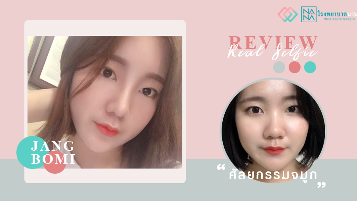รีวิวเสริมจมูก ปั้นทรงสวยเหมาะกับหน้า คุณจางโบมี (ตอนที่ 2)
