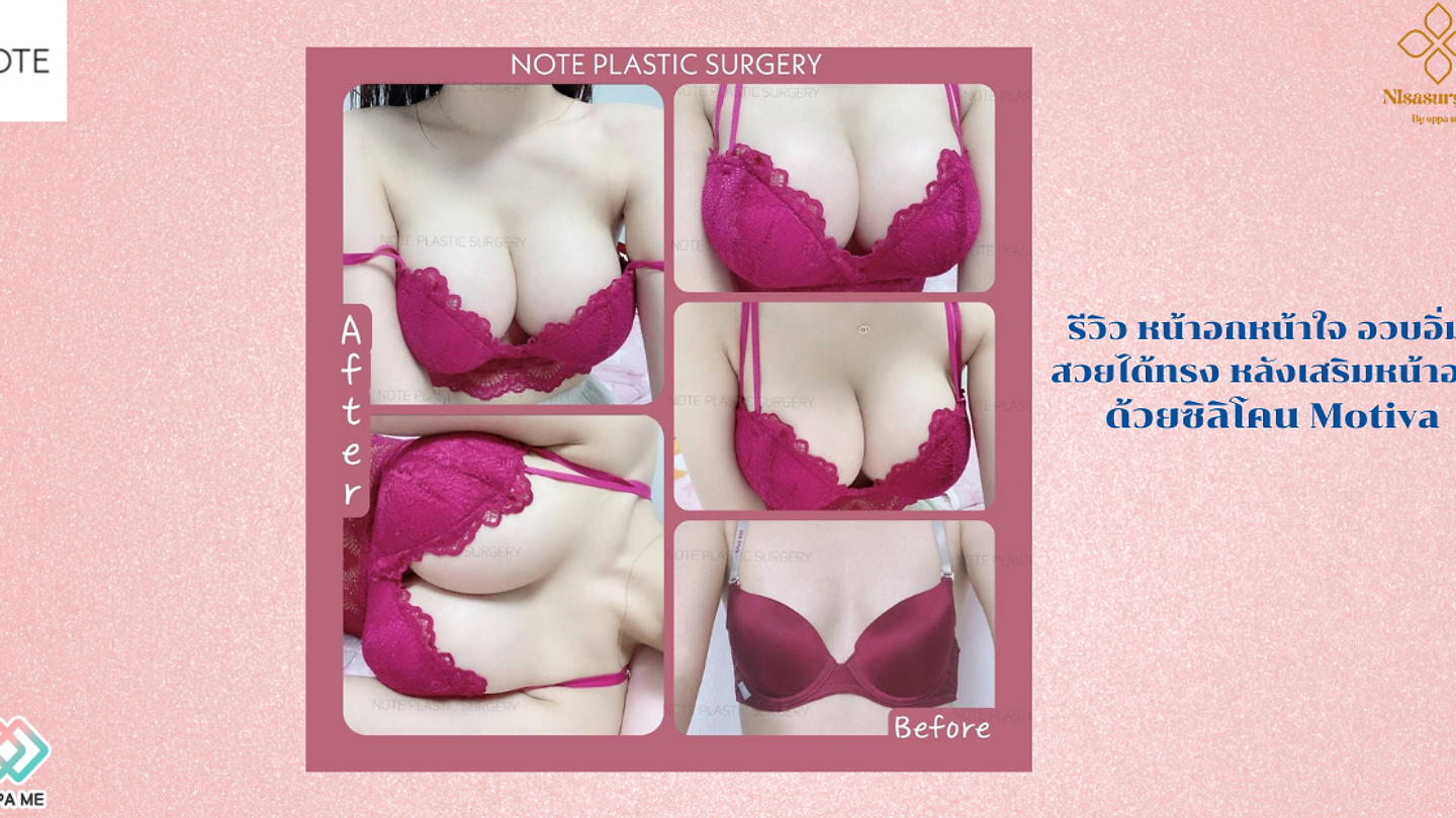 Note Plastic Surgery รีวิว หน้าอกหน้าใจ อวบอิ่ม สวยได้ทรง หลังเสริมหน้าอก ด้วยซิลิโคน Motiva (ตอนที่ 1)