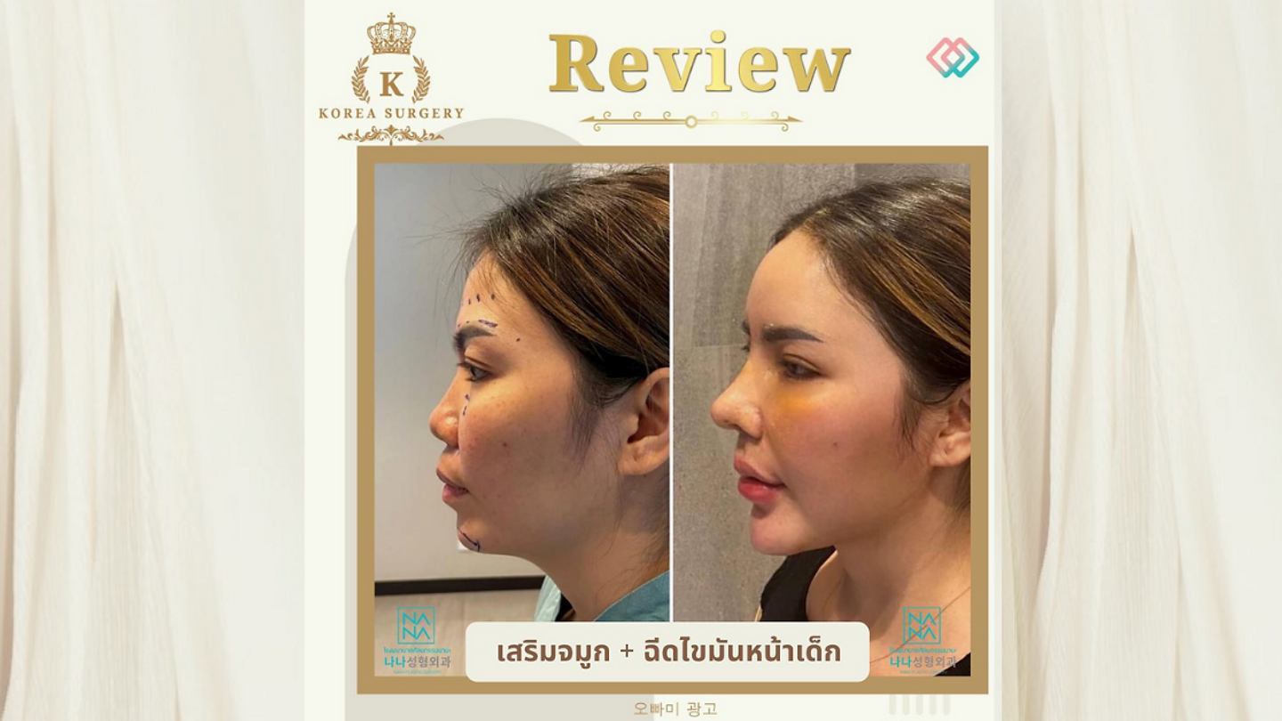 รีวิวเสริมจมูก เสริมสัน+แต่งปลาย + ฉีดไขมันหน้าเด็ก แถมฟรี PRP (ตอนที่ 1)