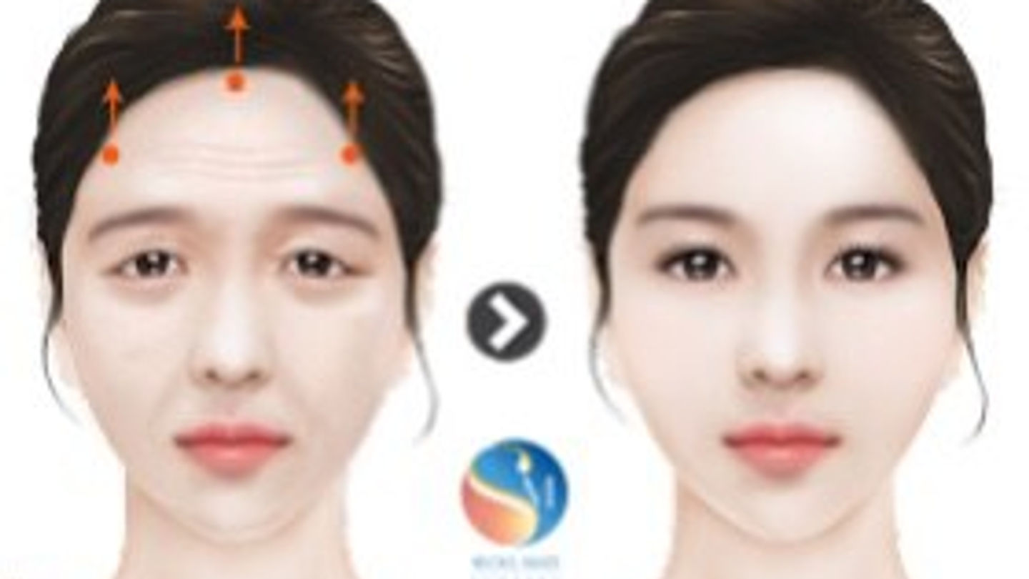 Endotine คืออะไร? มีใครสงสัยบ้างคะ