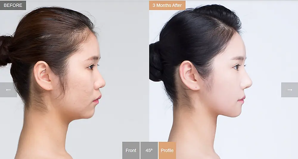 รีวิวศัลยกรรมแก้ไขคางหุบ
